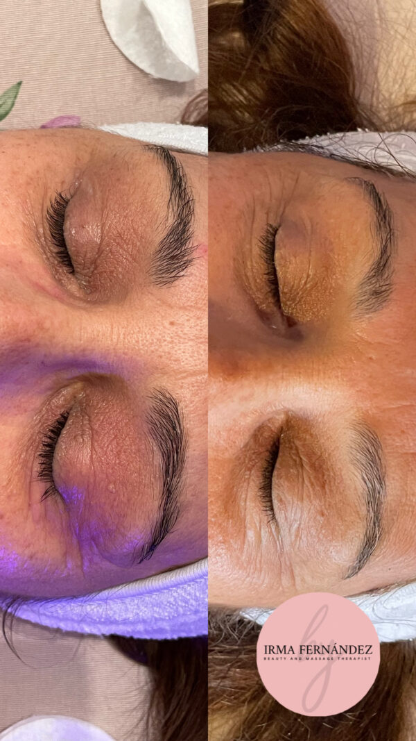 Bono 6 sesiones contorno de ojos